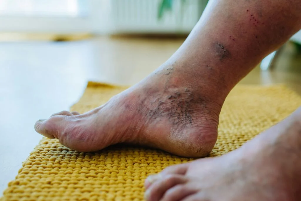 Diabetic Ulcer
